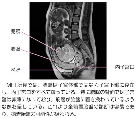 胎盤